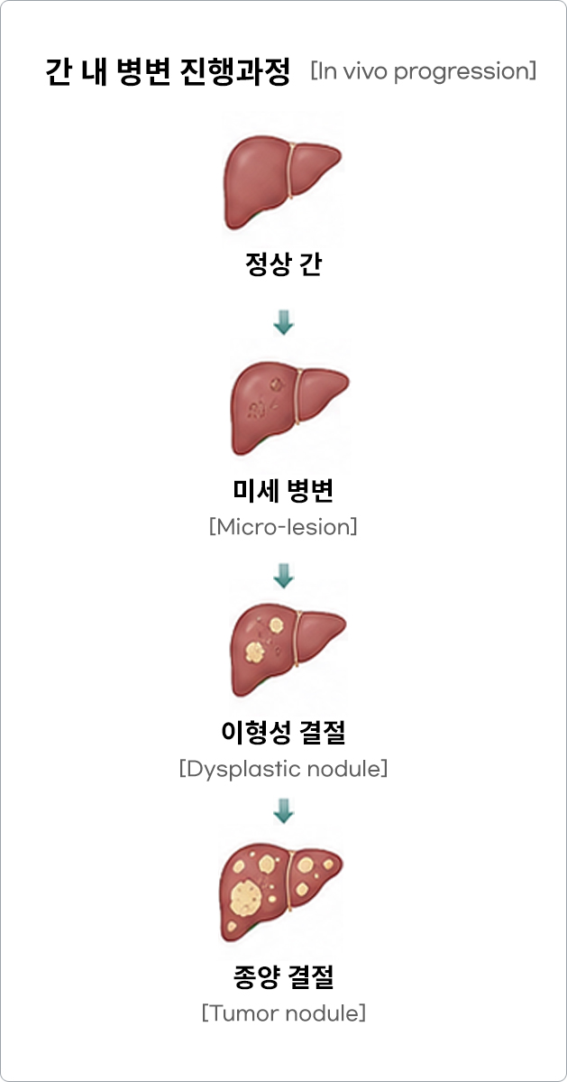 간 내 병변 진행과정 (모바일)